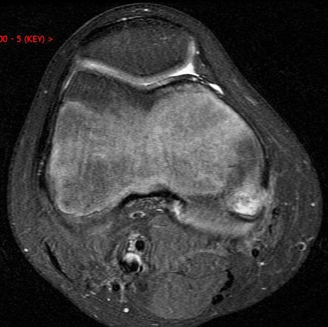 Figure 5 for case avulsion fracture MFC and tibial tubercle fx ( RID2896 ) ( RID4653 )